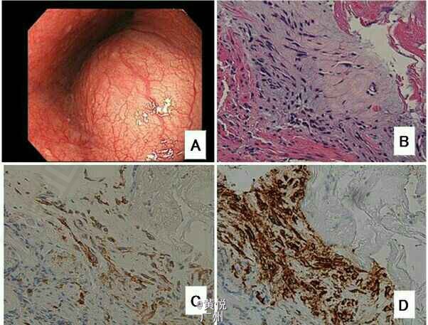 食管间质瘤一例