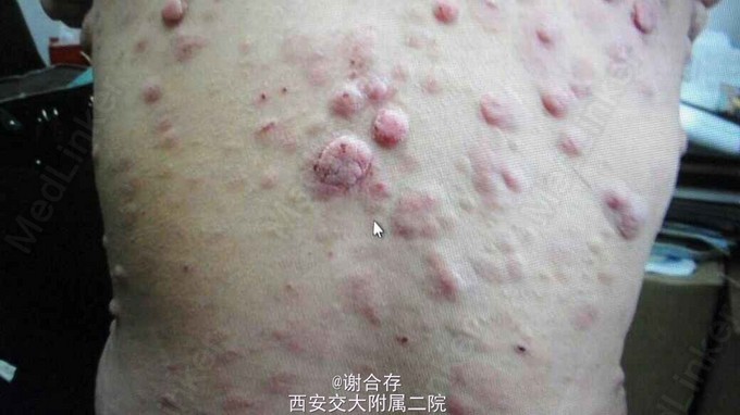 医联#蕈样肉芽肿一例