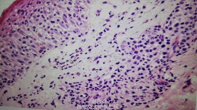 医联#蕈样肉芽肿一例