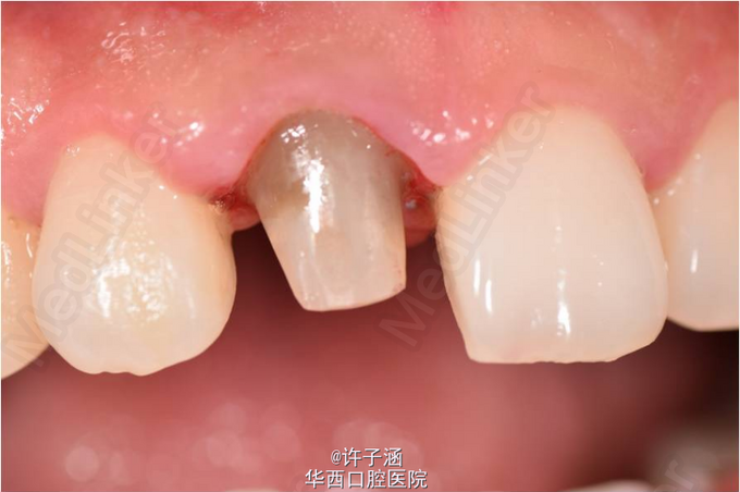 上前牙桩核冠修复