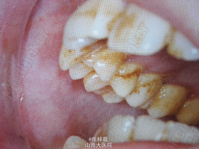 双颊黏膜,软腭后份黏膜发白,质较硬,可扪及明显的纤维条索.