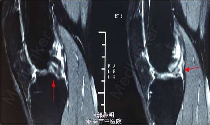 查体:双下肢无畸形,左膝关节无静脉曲张,肿胀等,皮温正常,关节间隙