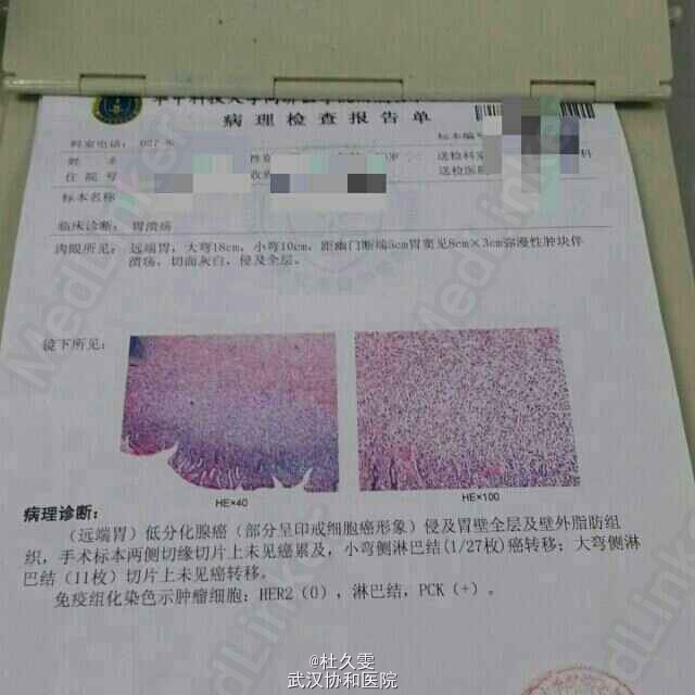 胃低分化腺癌一例