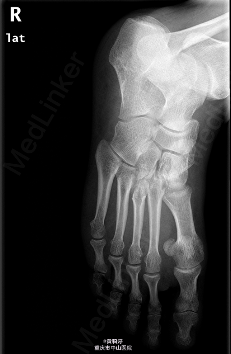 急送至当地医院拍片示右足内侧楔骨,第1-3跖骨基底部骨折.