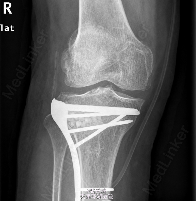右胫骨平台粉碎性骨折 医联