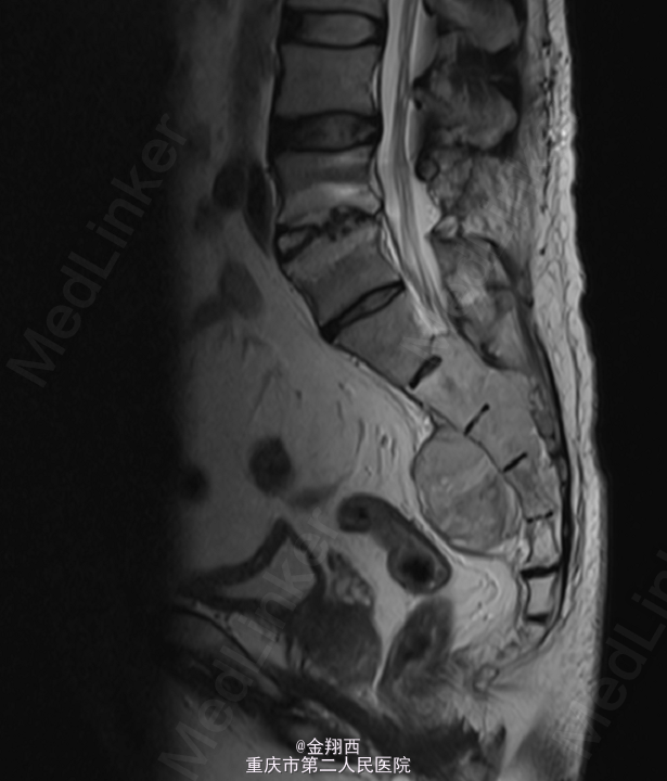 骶骨肿瘤1例