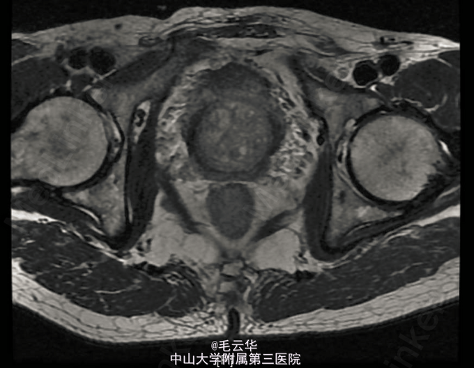 腹腔镜下前列腺癌根治术1例 医联