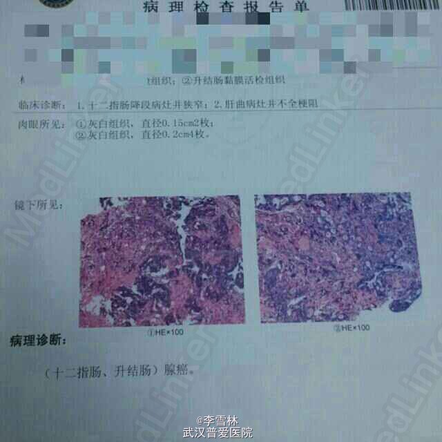 升结肠低分化腺癌