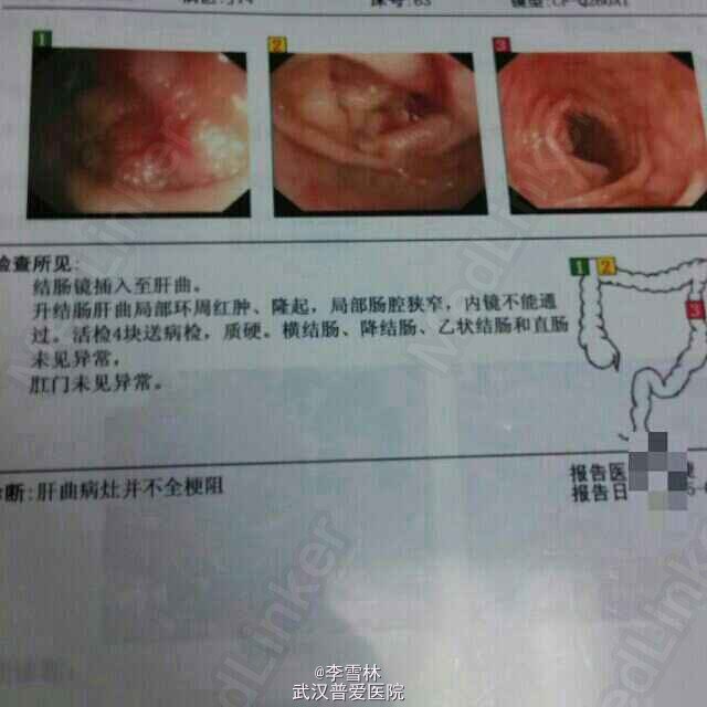 升结肠低分化腺癌