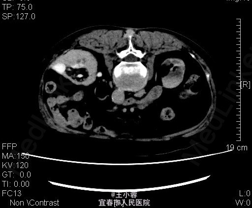 县人民医院 腹部b超：双肾弥漫行病变，符合肾功能受损改变，双肾囊肿，