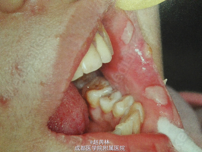 口腔梅毒粘膜斑
