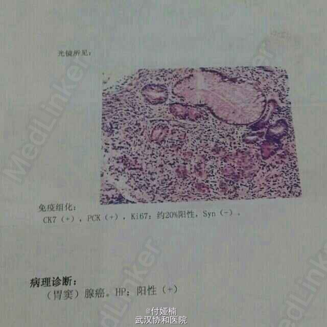 胃窦腺癌一例