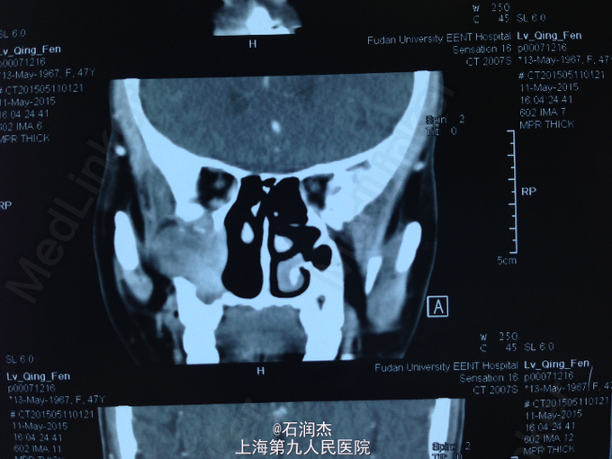 #医联#复发性鼻腔鼻窦内翻性乳头状瘤一例-医联