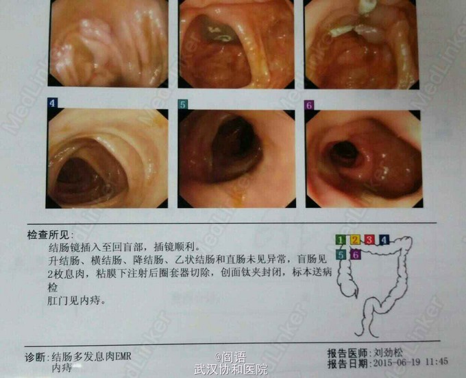 回盲部绒毛状管状腺瘤一例