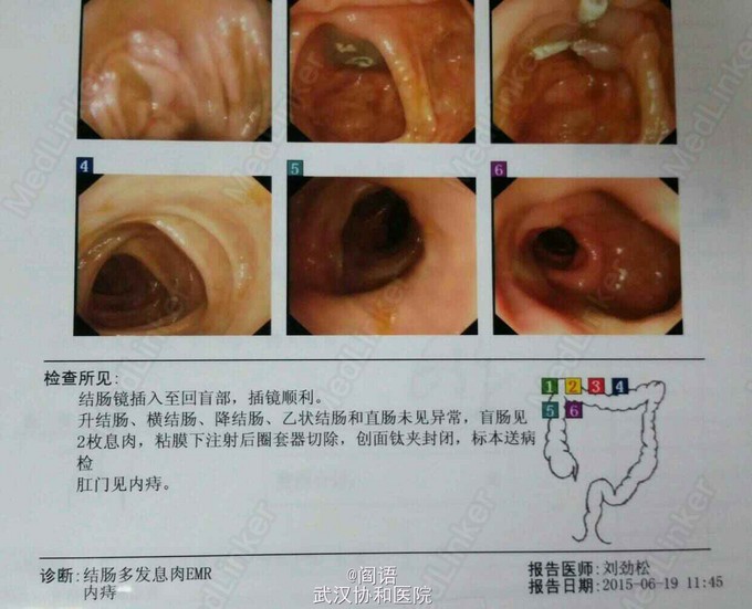 回盲部图片大全 Uc今日头条新闻网