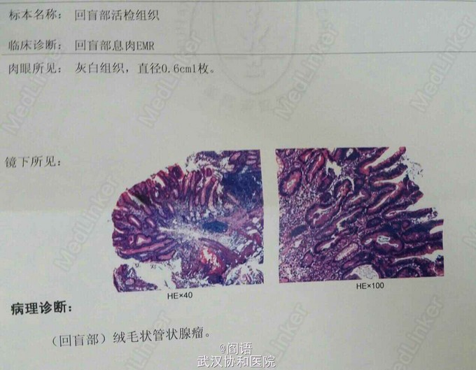 回盲部绒毛状管状腺瘤一例