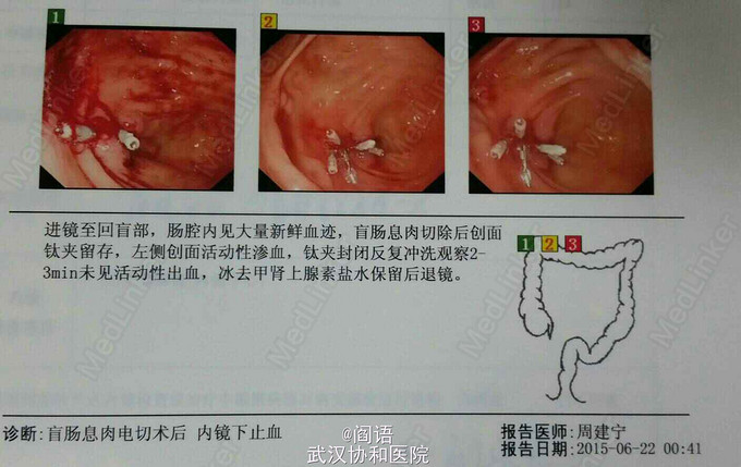 现病史:患者一日前肠镜检查发现回盲部多发息肉,无腹痛,腹胀,腹泻,无