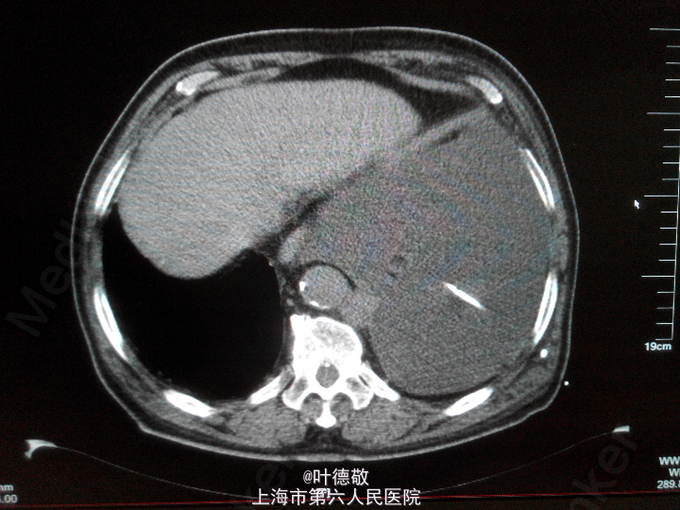 i型呼吸衰竭,大量胸腔积液并肺不张