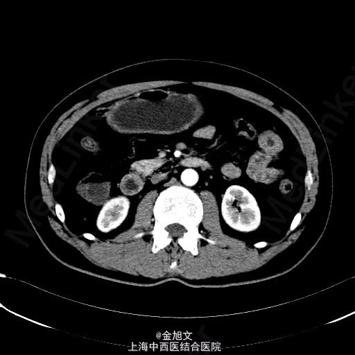 胃窦恶性肿瘤，肝囊肿-医联