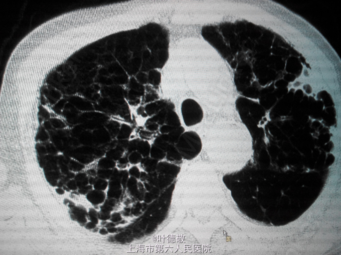 蜂窝肺肺间质纤维化合并感染