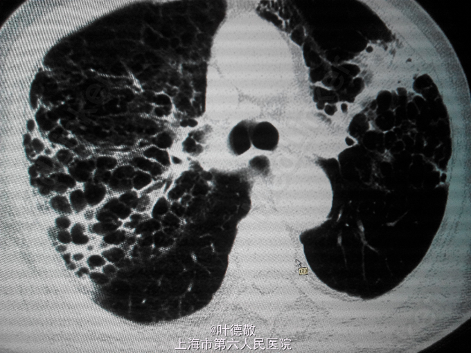 蜂窝肺肺间质纤维化合并感染