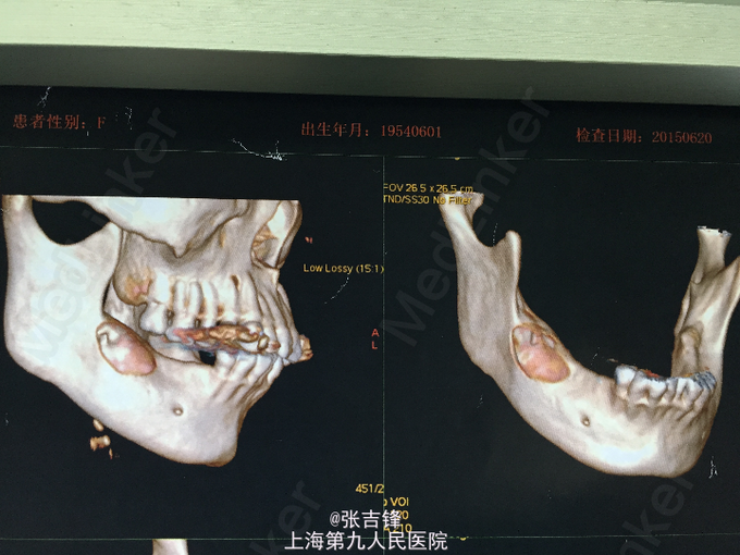 下颌骨囊肿摘除术