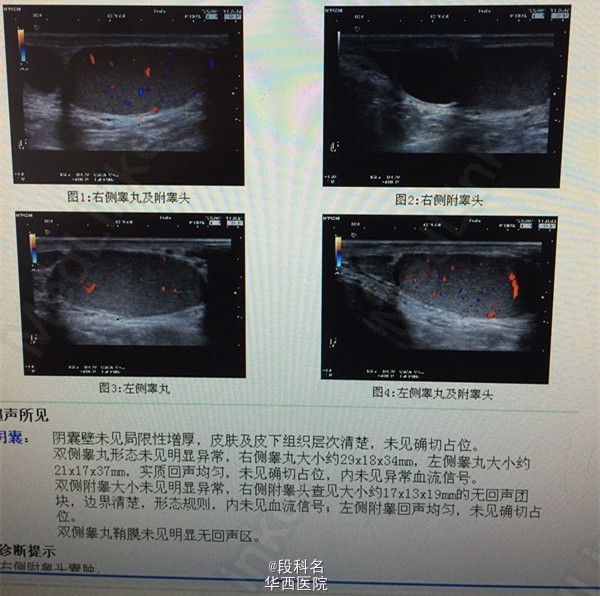 附睾囊肿