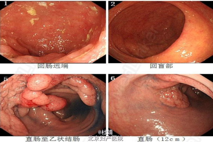 乙状结肠腺瘤一例