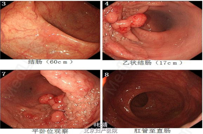 乙状结肠腺瘤一例