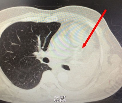 辅助检查:胸部ct:左主支气管闭塞,中心型肺癌可能,左肺不张.