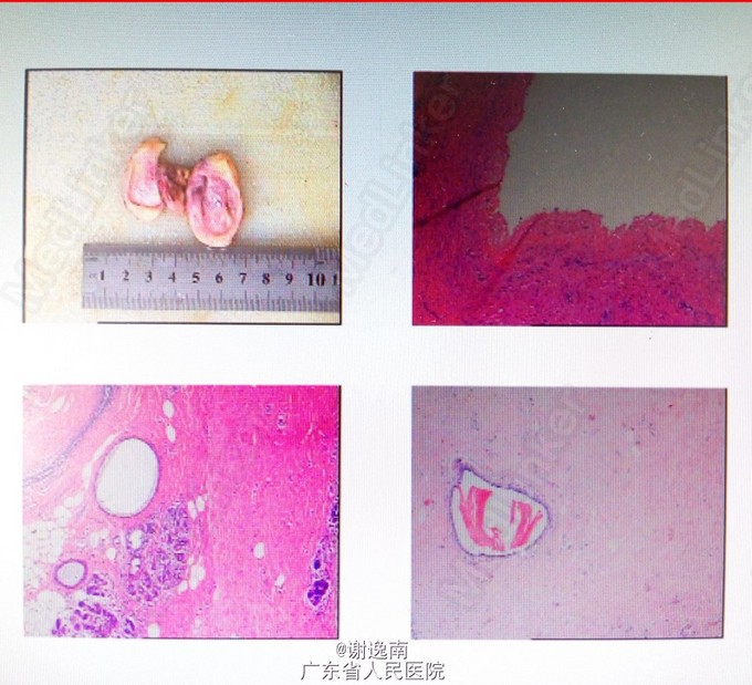 左侧乳腺纤维腺瘤