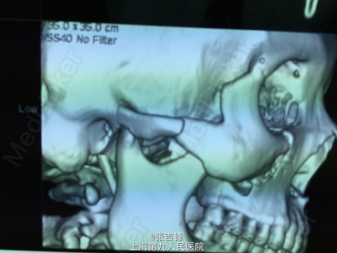 颧骨颧弓骨折手术治疗