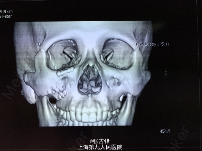 颧骨颧弓骨折手术治疗