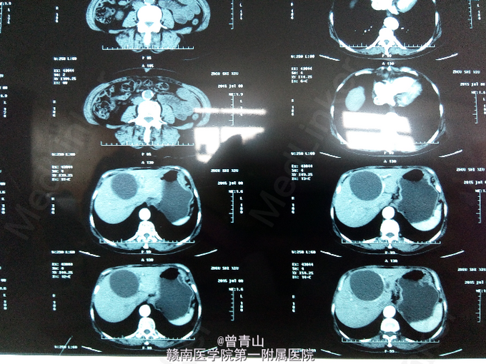 肝囊肿一例