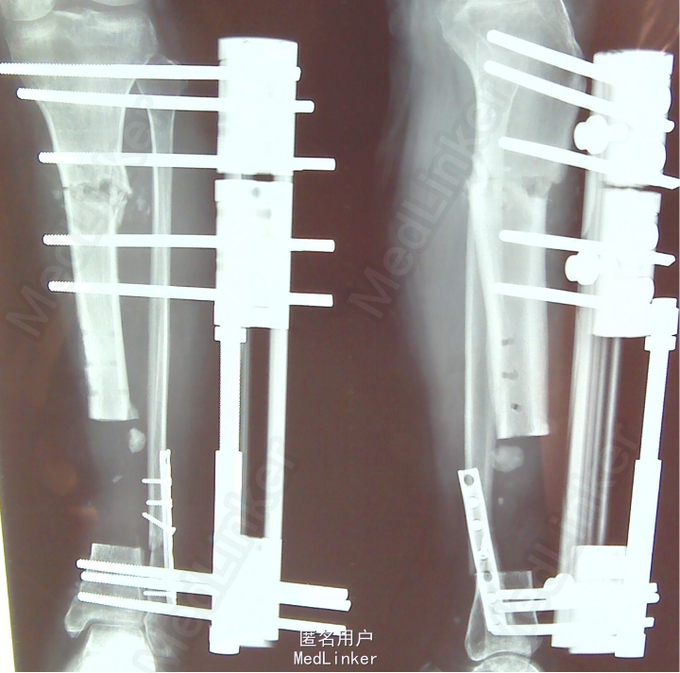 胫腓骨双折术后胫骨慢性骨髓炎的处理.