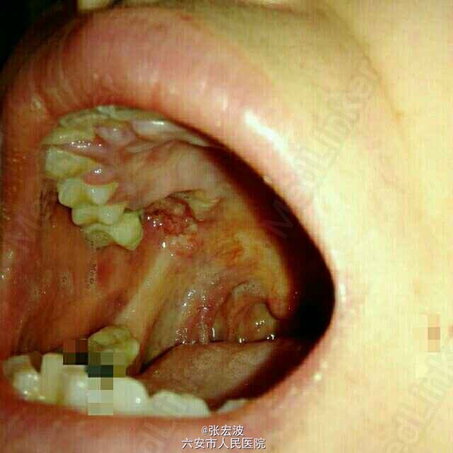牙龈癌1例