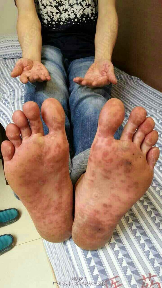 成人手足口病1例