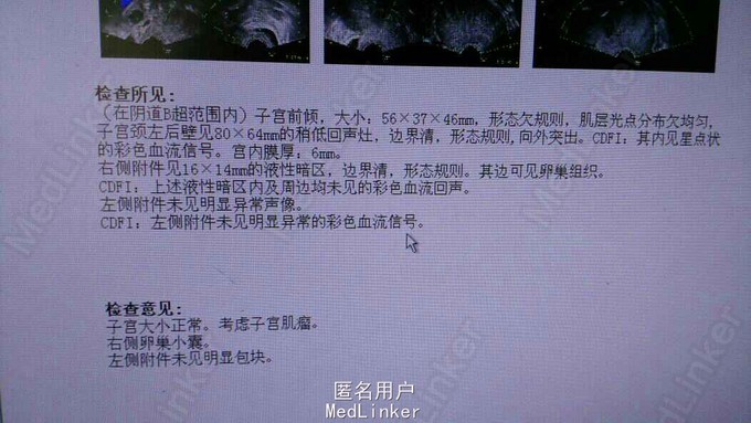 宫颈肌瘤,腹腔镜下剔除一例!