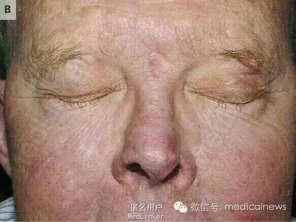 皮肤t细胞淋巴瘤