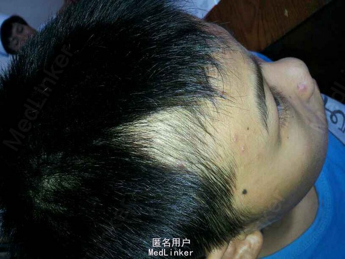 拔毛癖1例