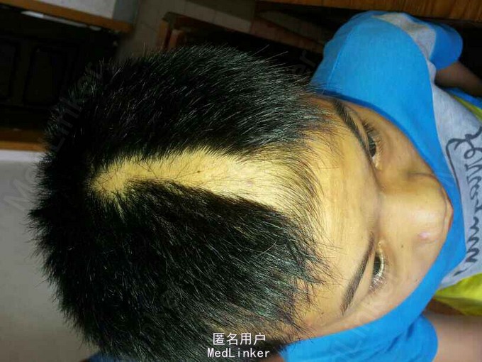 拔毛癖1例