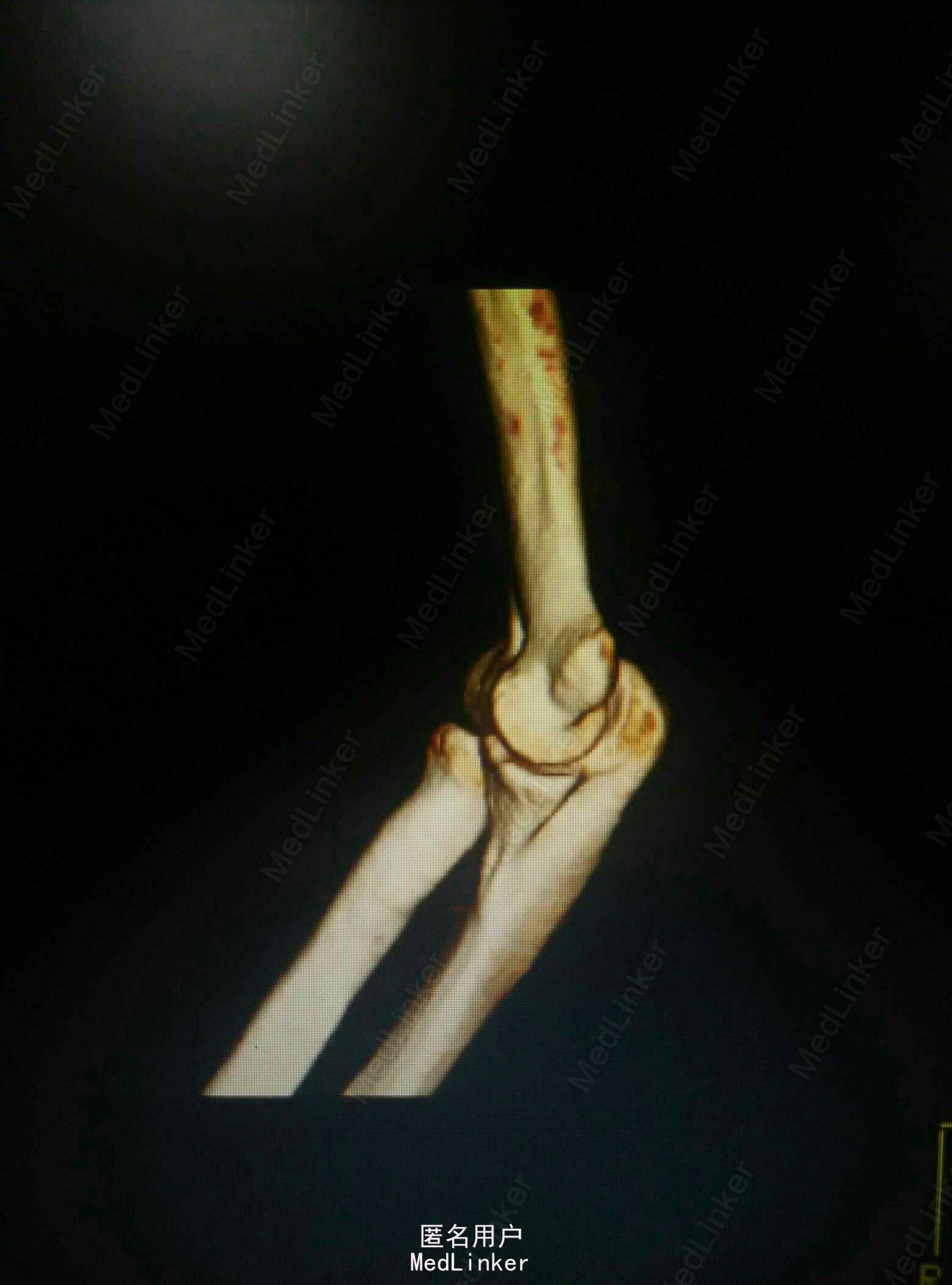 骨科基础 : 肘关节的关节镜入路汇总_医学界-助力医生临床决策和职业成长
