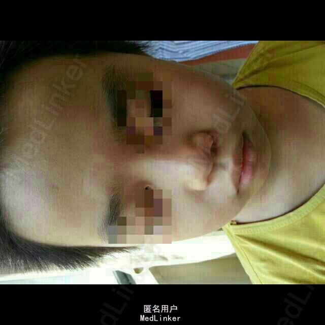 随访 讨论 本病是一种先天性局限性白斑,又称脱色素痣.