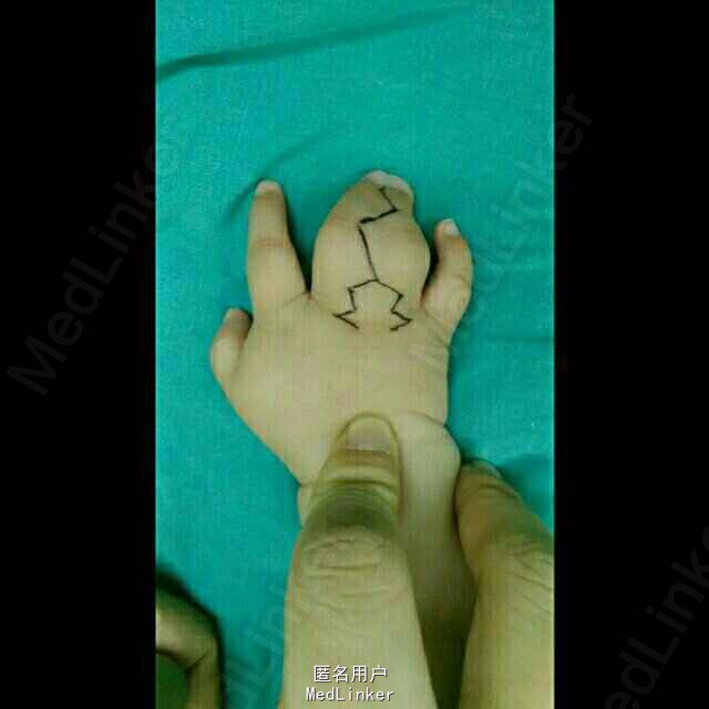 右手3,4指并指伴3,4指间多指 治疗:采用田晓菲教授"双翼"皮瓣法成形指