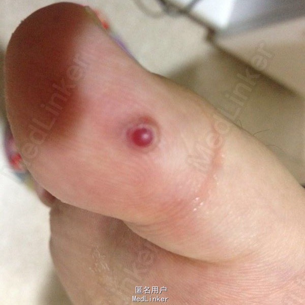 病理变化特征为血管增生性肉芽肿,有时形成溃疡.