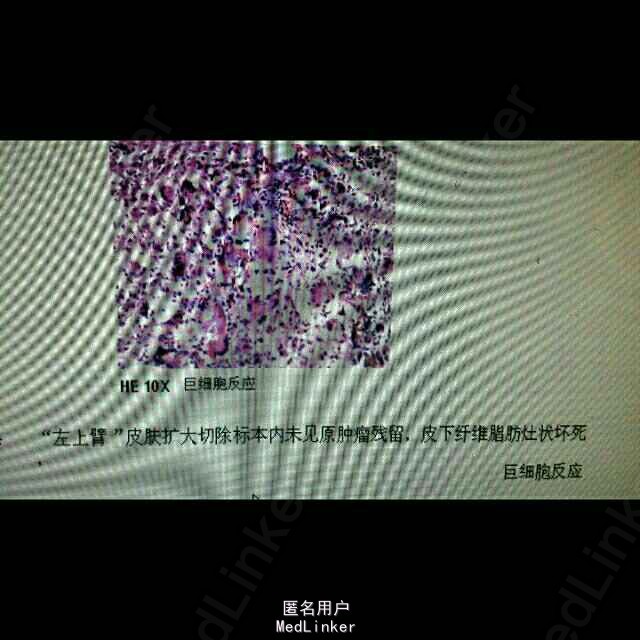 皮肤纤维肉瘤一例