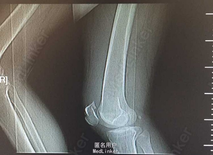 诊断 处理 右膝关节x片示:右髌骨粉碎性骨折,骨折移位.初步诊断:1.