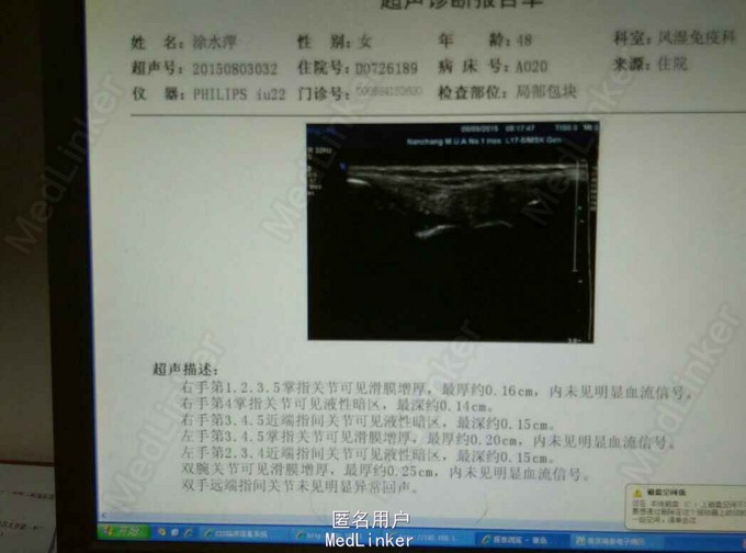 混合性结缔组织病