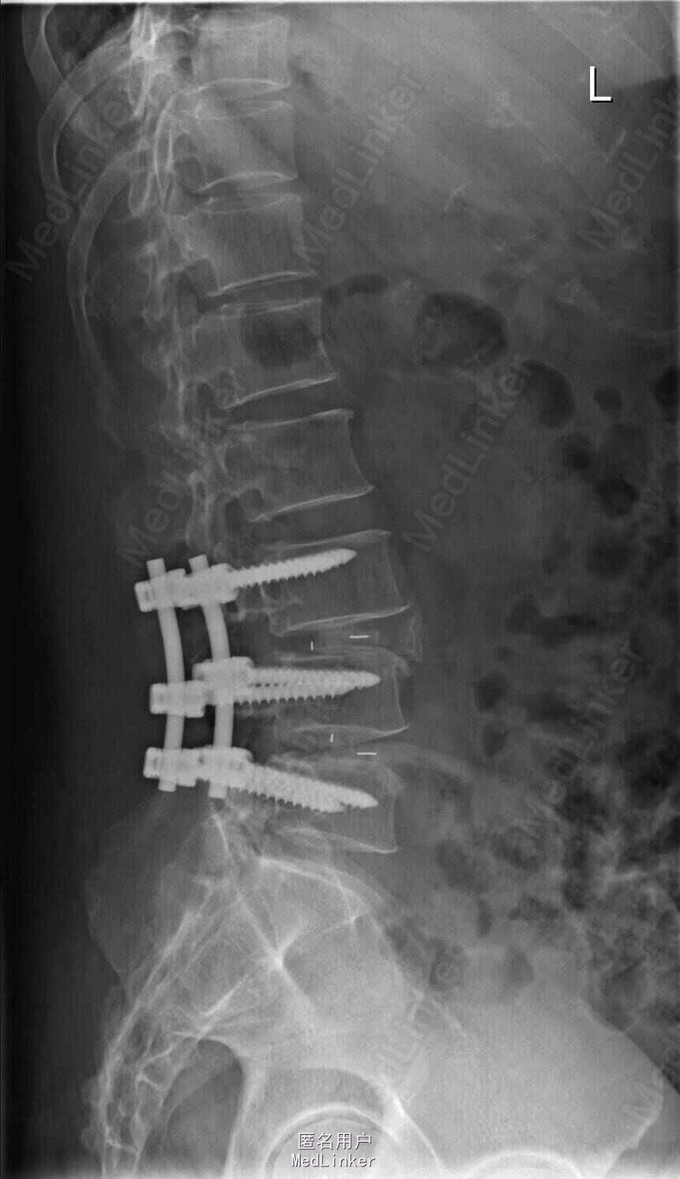 腰椎后路减压融合内固定术