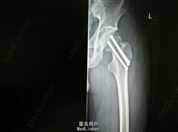 一例股骨颈骨折闭合复位内固定